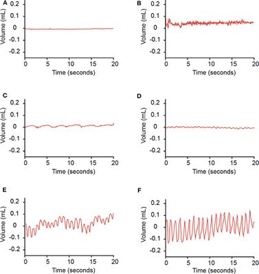 Ambient Pressure Tympanometry Wave Patterns in Patients With Superior Semicircular Canal Dehiscence